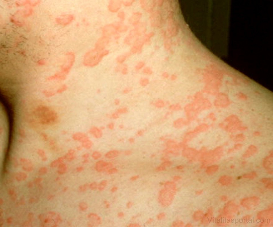 Anafilaxiás sokk alakul ki, ha az allergiás reakció súlyossá válik.