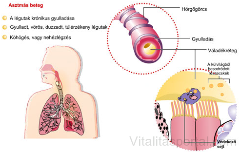 ascites asztma a vastagbelet természetes módon méregteleníti