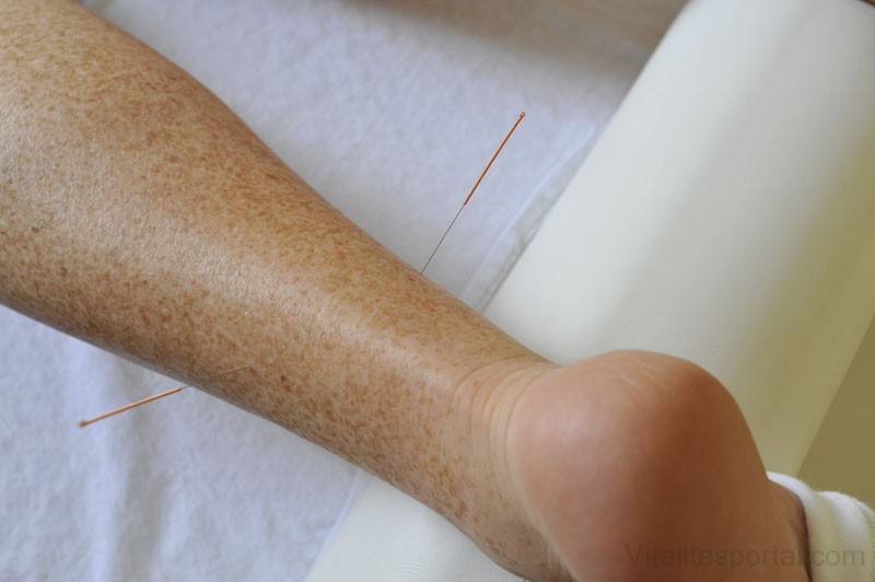 Az azstmára jó hatással van az akupunktúra kezelés? 