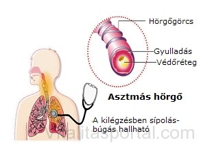Asztmás hörgő