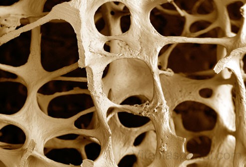 A szteroidok csontritkulást okozhatnak!