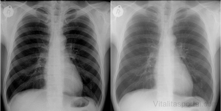 Mellkasröntgen: a tüdő belsejét megmutató röntgenfelvétel segít kizárni a tüne­tek egyéb lehetséges okait.