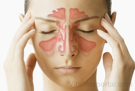Az allergiás nátha általánosan jellemző tünetei a tüsszö­gés, az orrdugulás, ami nagyon kellemetlen tud lenni.
