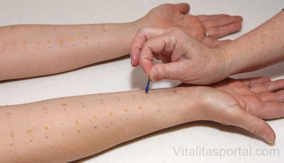 Szúrásos teszt, amely könnyen kimutatja mire vagyunk allergiásak. 