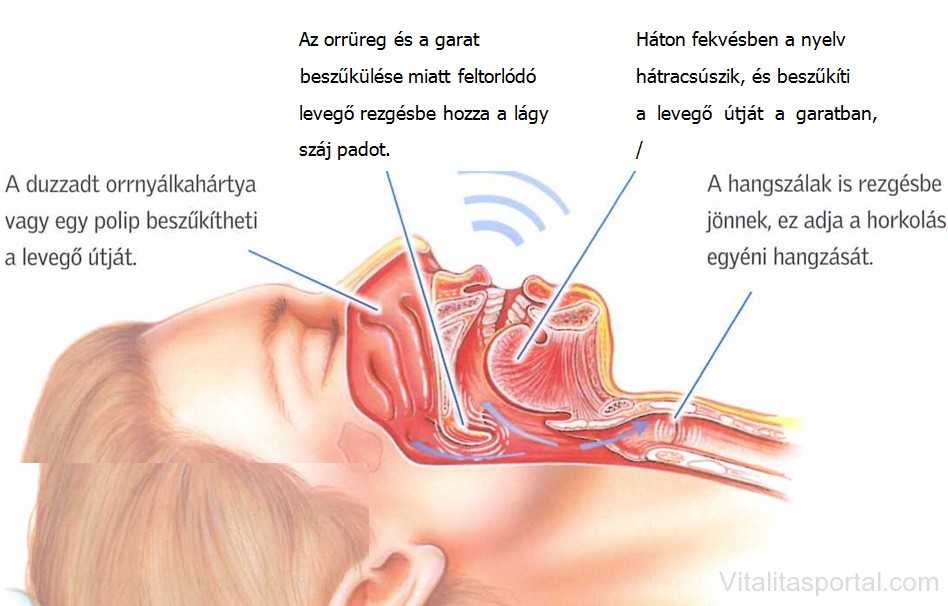 El és átalvási zavarok: horkolás okai (ábrával) A horkolás okai