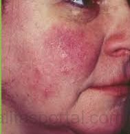 Felére csökken a rozácea heveny kiújulásának kockázata, ha az antibioti­kum-kúra után fél éven keresztül rendszeresen bekenjük az arcbőrt az orvos által felírt gyógyhatású krémmel.