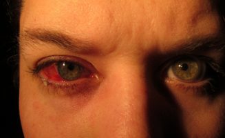 A szemnyomást csökkentő cseppek rendszeres alkal­mazásával felére mérsék­lődik a látáskárosodás kockázata.
