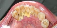 A fogkő és a plakk elrondítja a fogakat, és kellemetlen szájszagot okoz