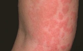 A gyermekek veszélyeztetettebbek, de allergiás reakcióként bár-kinél előfordulhat csalánkiütés -ez a viszkető bőrkiütés.