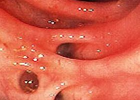 A divertikulumok olyan nyálkahártya-kiboltosulások, amelyek a vastagbél meggyengült falán át dudorodnak ki.