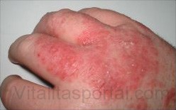 A dermatitisz - általános elnevezése a bőrt érintő nem fertőzéses eredetű gyulladásnak - nagyon gyakori.