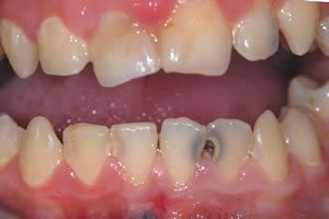 A legtöbb embernek a felnőttkor elérésekor már van néhány szuvas foga.