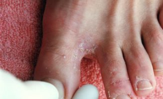 A lábgombásodás igen gyakori gombás fertőzés, bárki elkaphatja. Csökkent védekezőképesség, cukorbaj hajlamosít rá.