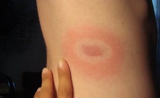Bárki, akit a Borrelia burgdorferi nevű baktériumot hordozó kullancs megcsíp, megkaphatja a Lyme-kórt.
