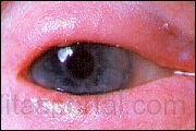 Az ótvar és a seborrhoeás bőrgyulladás növeli a szemhéjgyulladás - szaknyelven blepharitis - kockázatát.