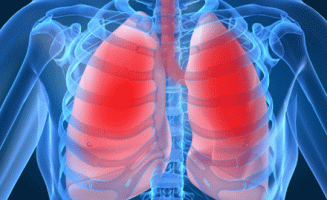 A vírusos tüdőgyulladás enyhe formáját gyakran súlyos náthának vagy influenzának nézik.