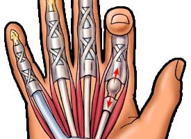 Az egyébként egészséges személyeknél az ujjak alakjának elváltozása gyakran a kezet ért sérülés vagy sportbaleset miatt alakul ki.