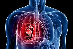 A tüdődaganatok több mint 90 százaléka rosszindulatú. A tüdőrák a légutak (tüdő, hörgők, légcső) területén alakul ki.