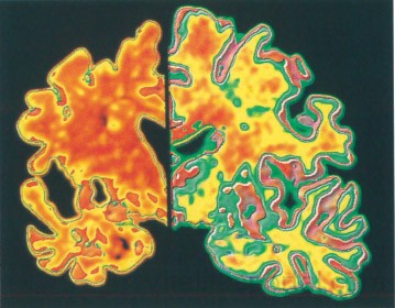 Alzheimer-kóros agy