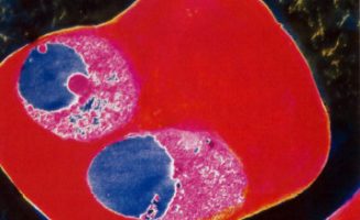 Maláriával fertőzött vörösvérsejt