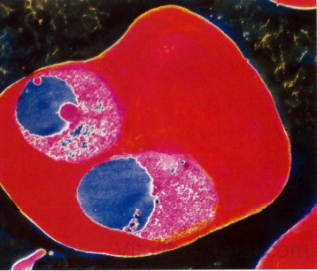 Maláriával fertőzött vörösvérsejt