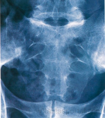 Röntgenfelvétel medencéről