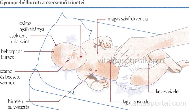 Gyomor-bélhurut tünetei csecsemőknél
