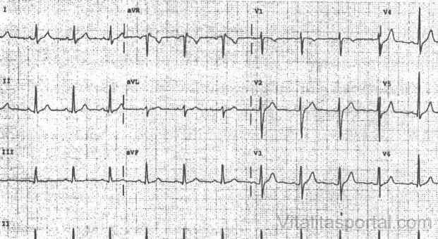 EKG felvétel