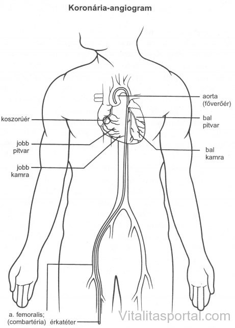 Koronária-angiogram