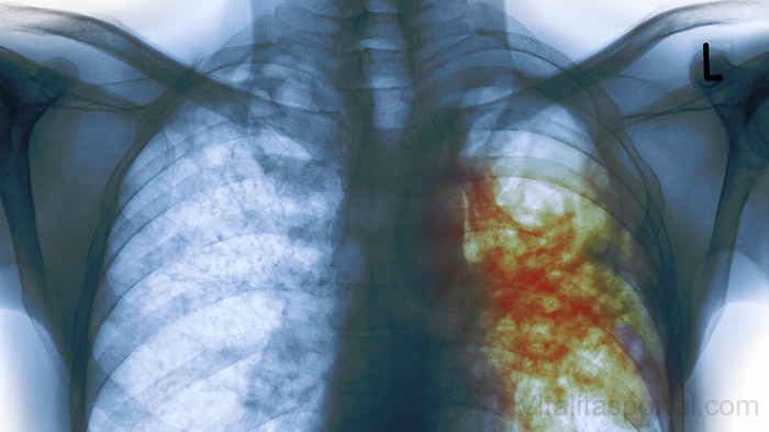 TBC - röntgentkép